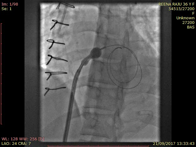 ECMO-IABP-3