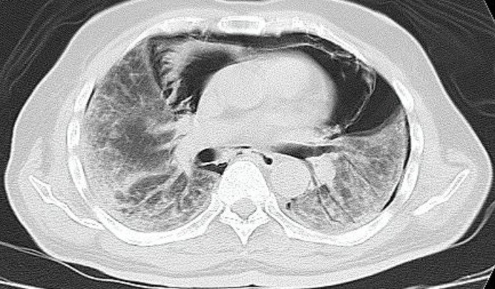 Spontaneous-Pneumomediastinum-10