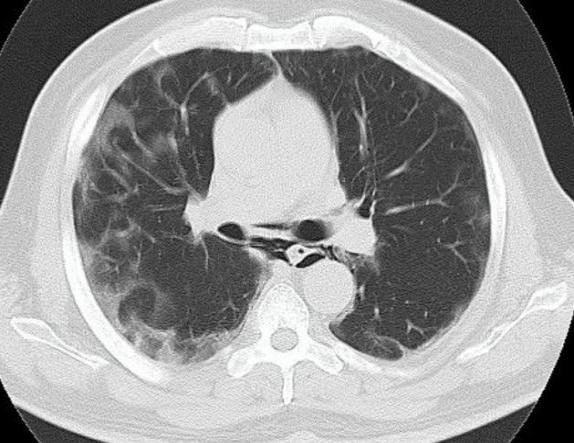 Spontaneous-Pneumomediastinum-2