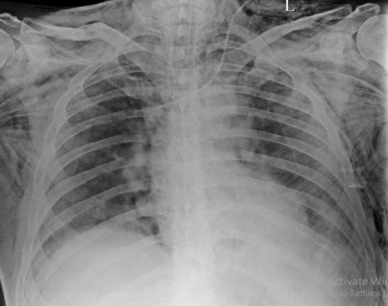 Spontaneous-Pneumomediastinum-4