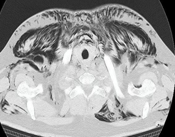 Spontaneous-Pneumomediastinum-5