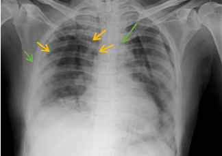 Spontaneous-Pneumomediastinum-8