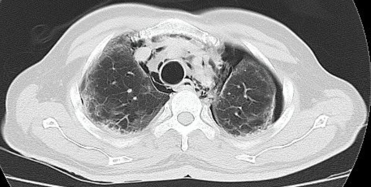 Spontaneous-Pneumomediastinum-9