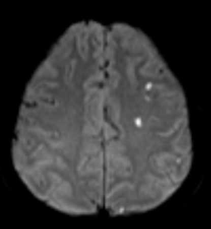 Subclavian-steal-1