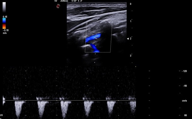 Subclavian-steal-5