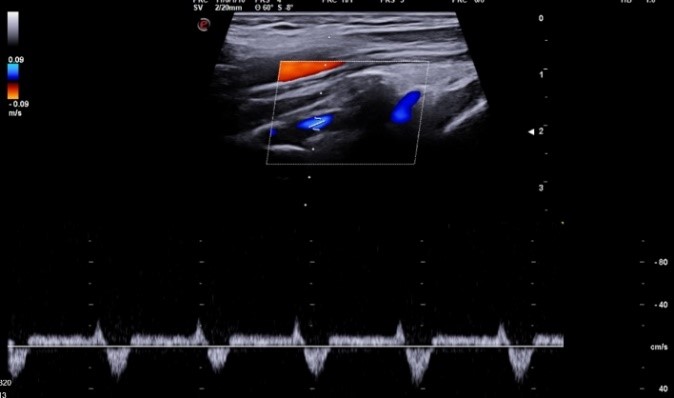 Subclavian-steal-50
