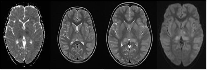 Japanese-Encephalitis