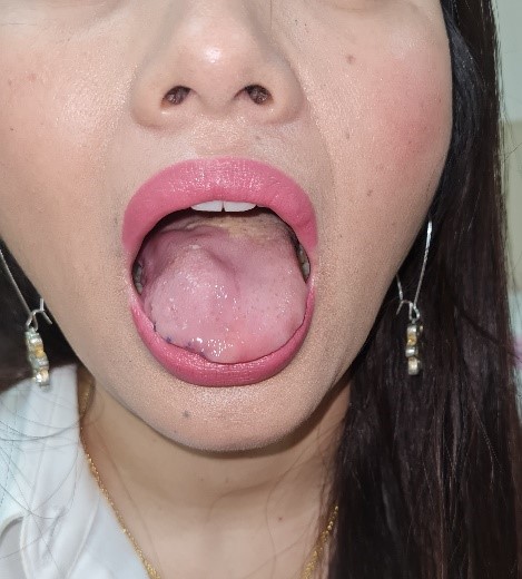 Lymphatic-malformation-of-tongue-1