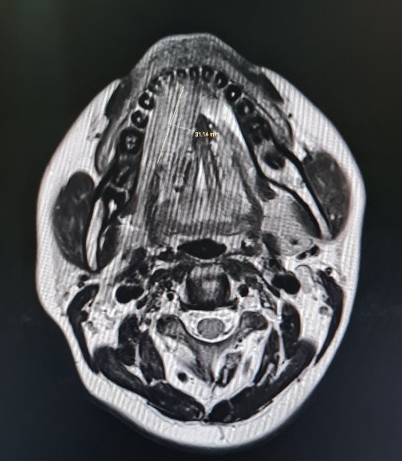 Lymphatic-malformation-of-tongue-3