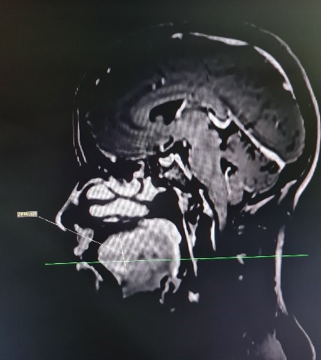 Lymphatic-malformation-of-tongue-4