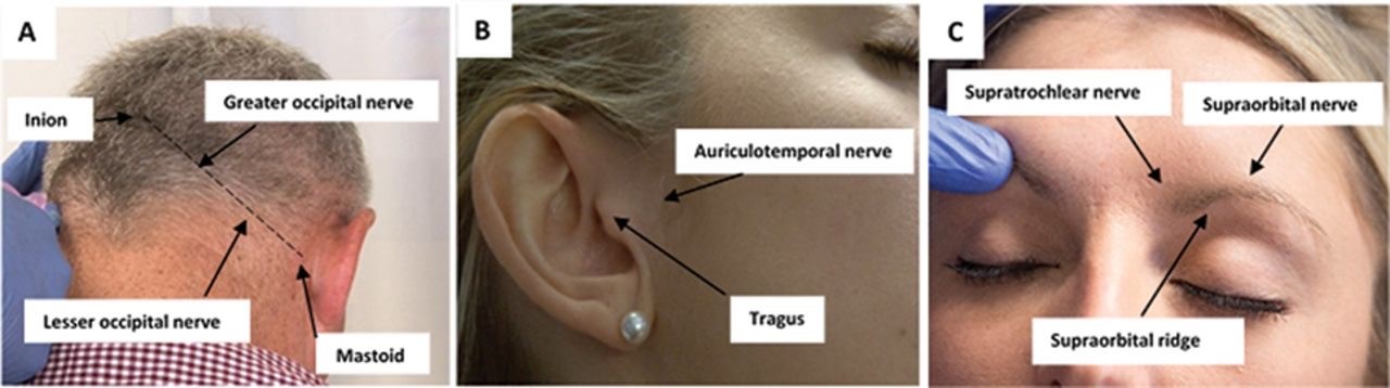 Awake-Craniotomy-1