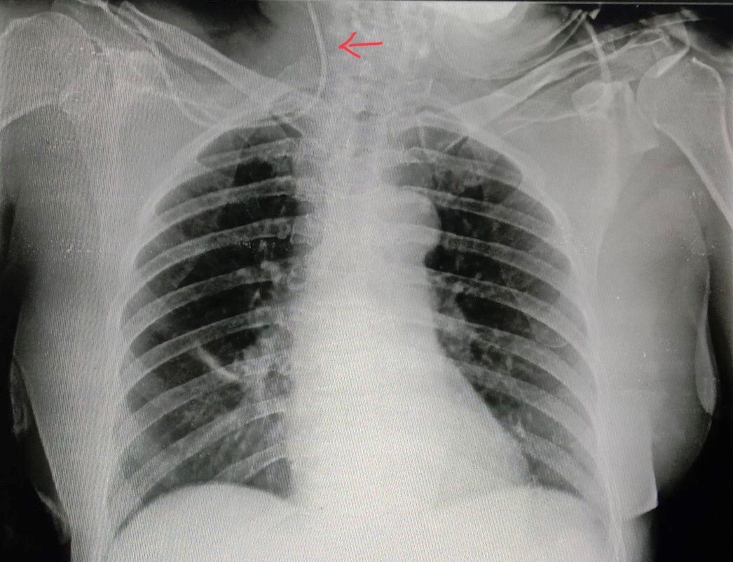 Left Subclavian Vein Central Line