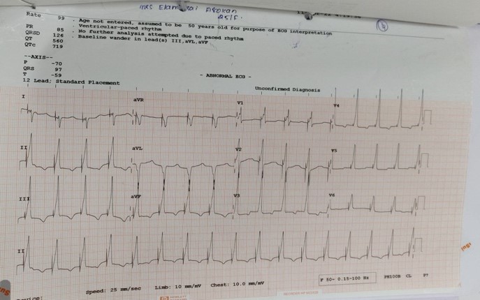 Stellate-Ganglion-Block-2