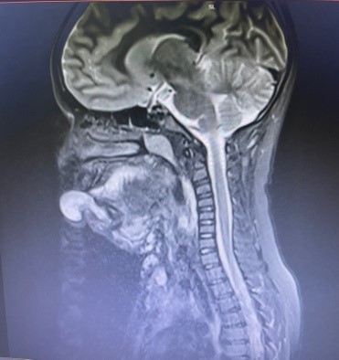 Venous-Malformation-in-Upper-Airway-2