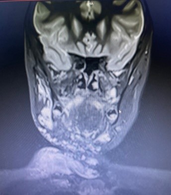 Venous-Malformation-in-Upper-Airway-3