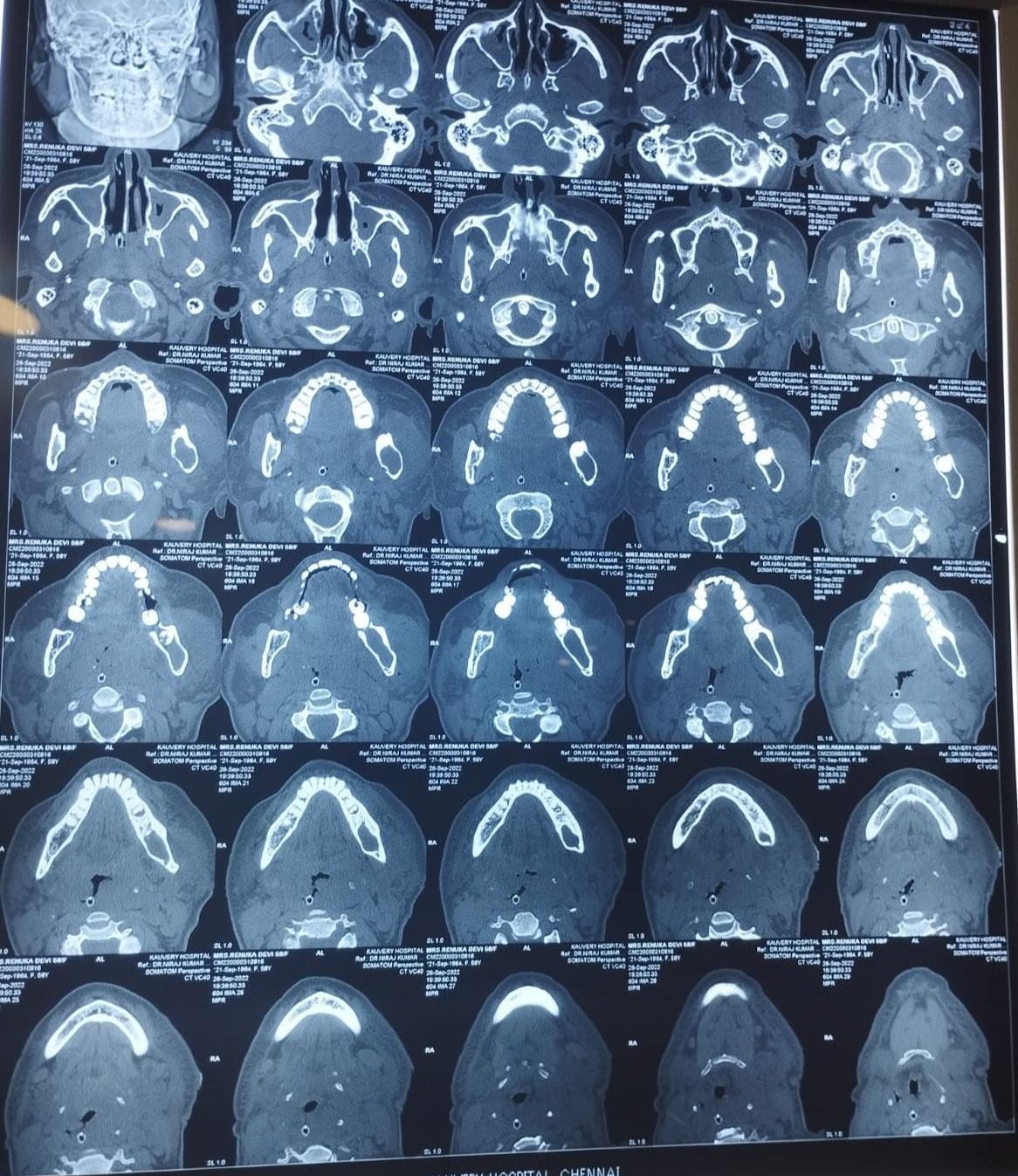 Parapharyngeal-abscess-2