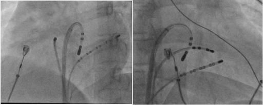 ablation-of-left-sided-slow-pathway-extension-near-the-posteromedial-mitral-annulus