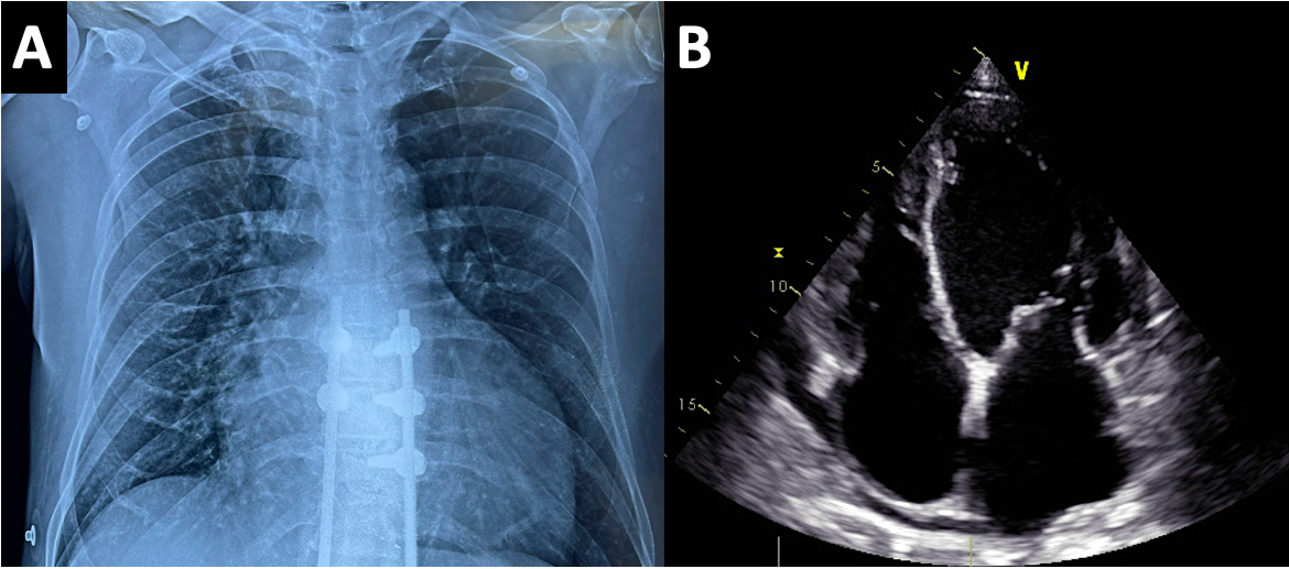 cardiac-resync1