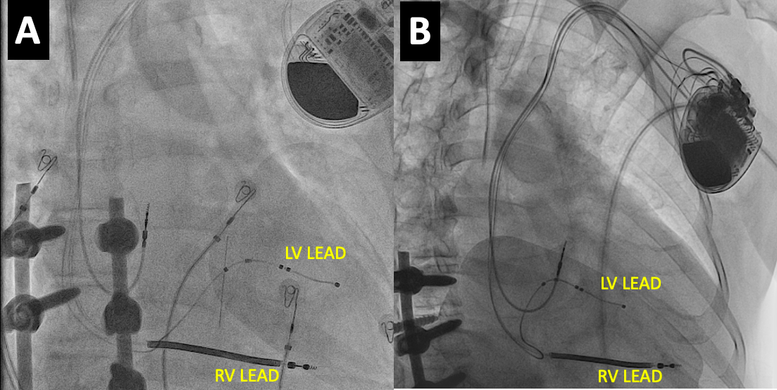 cardiac-resynch3