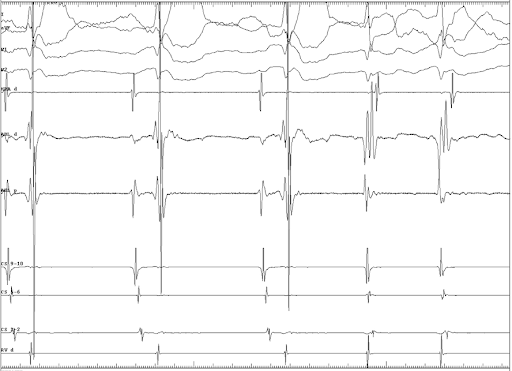 electrograms-at-the-left-sided-slow-pathway-region-Junctional-with-va-conduction-noted-during-ablation