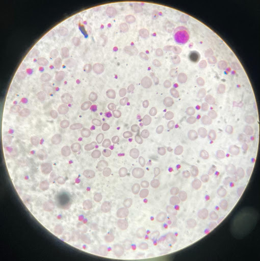 Reactive-thrombocytosis