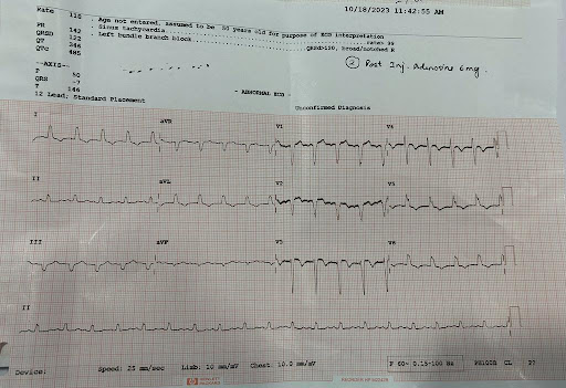 SVT WITH LEFT BUNDLE BRANCH BLOCK FOLLOWING GASTRECTOMY - Kauvery Hospital