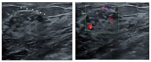 vague-hypoechogenicity-3