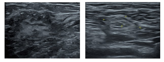 vague-hypoechogenicity-5