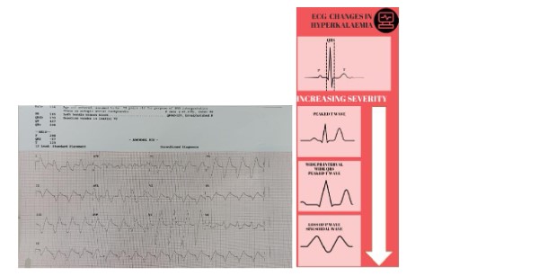 Hyperkalemia