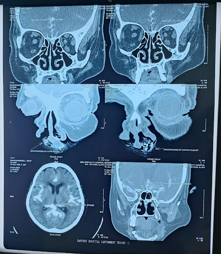 CT-cisternogram