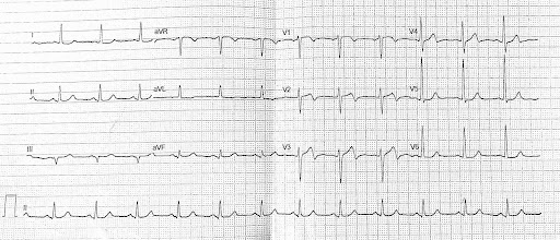 Eponymous-ECG-1