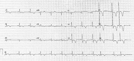 Eponymous-ECG-3