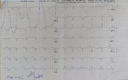 Her-outside-ECG-1