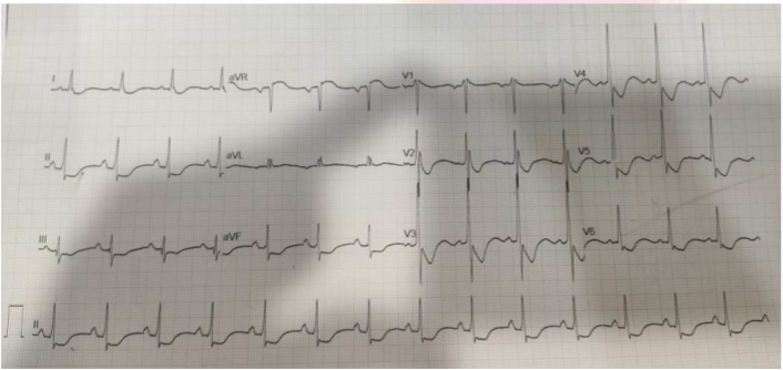 Hypokalemic1