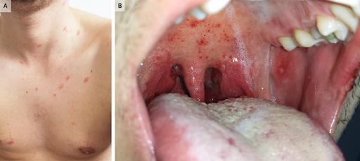 Lymphoma-5