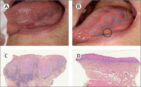 Lymphoma