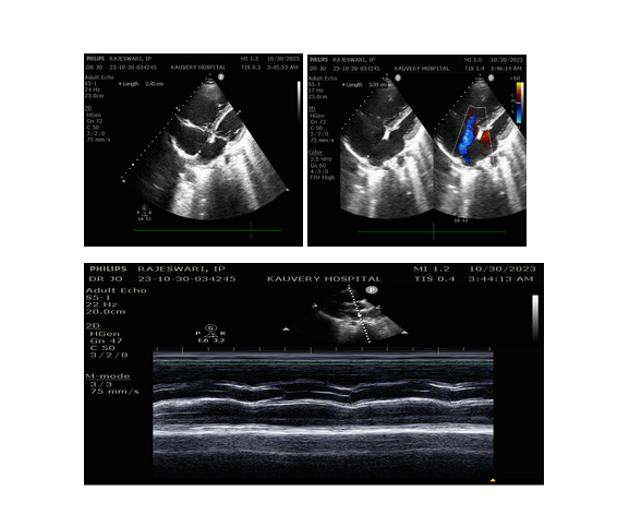 ECG-1