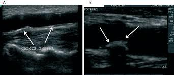 Doppler vascular mapping in Arterio Venous Fistula (AVF) - Kauvery Hospital