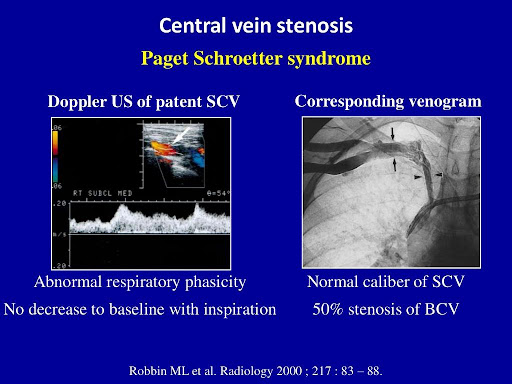 Longitudinal-image-of-the-vein-1