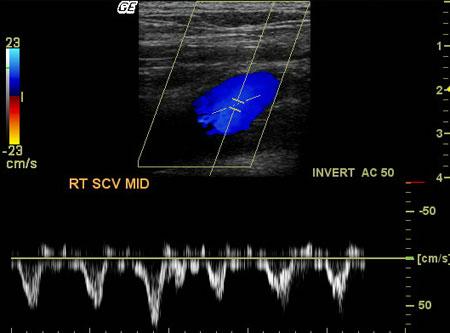 Longitudinal-image-of-the-vein