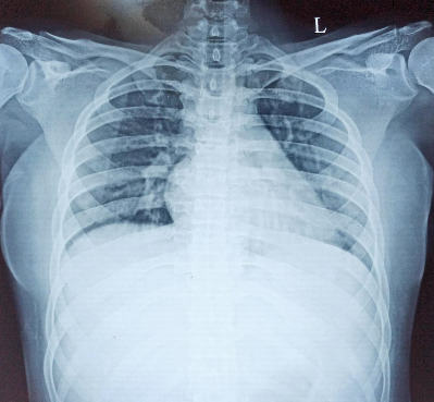 pulmonary-edema-1