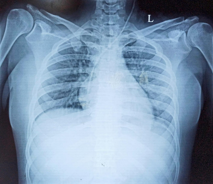 pulmonary-edema-2
