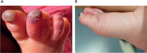 Blue-toes-in-a-neonate