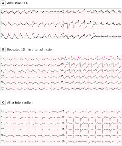 electrocardiogram