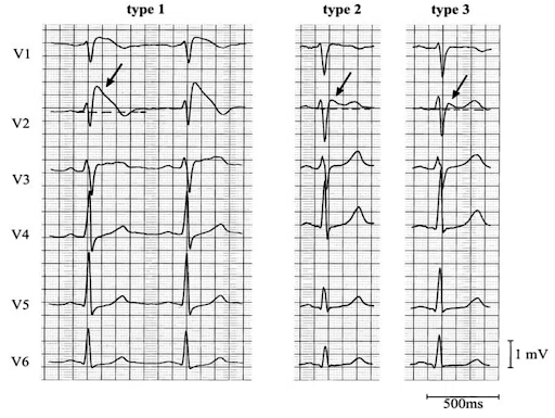 Brugada-syndrome