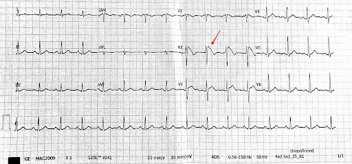 coved-ST-elevation