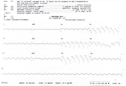 tachycardia-1