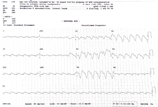 tachycardia-2