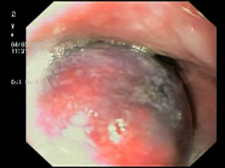 Unusual-cause-of-Dysphagia-2