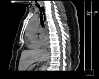 Unusual-cause-of-Dysphagia-4